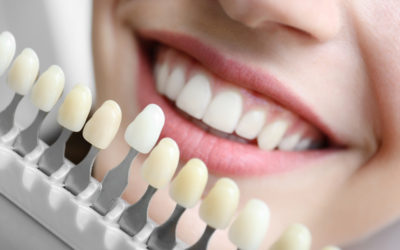 Lente de contato dental: será que eu posso usar?